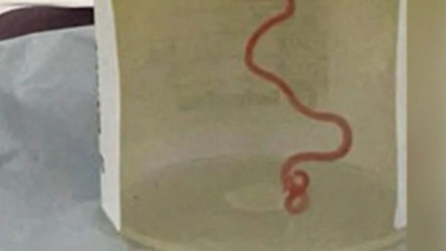 Extraen un gusano parásito de 8 centímetros “aún vivo y retorciéndose” del cerebro de una paciente por primera vez